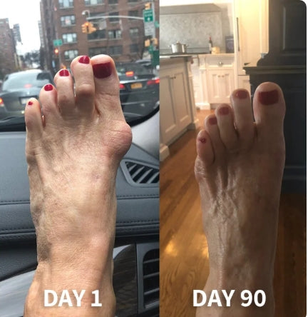OrthoZen™ – Correcteur Hallux Confort